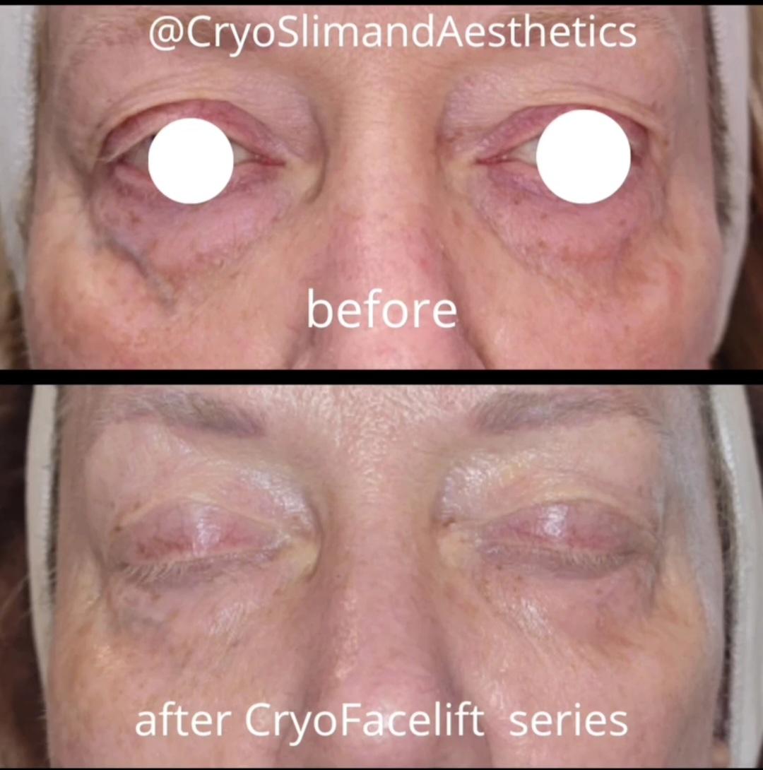 CryoSlim & Aesthetics — recovery studio in St Johns, FL